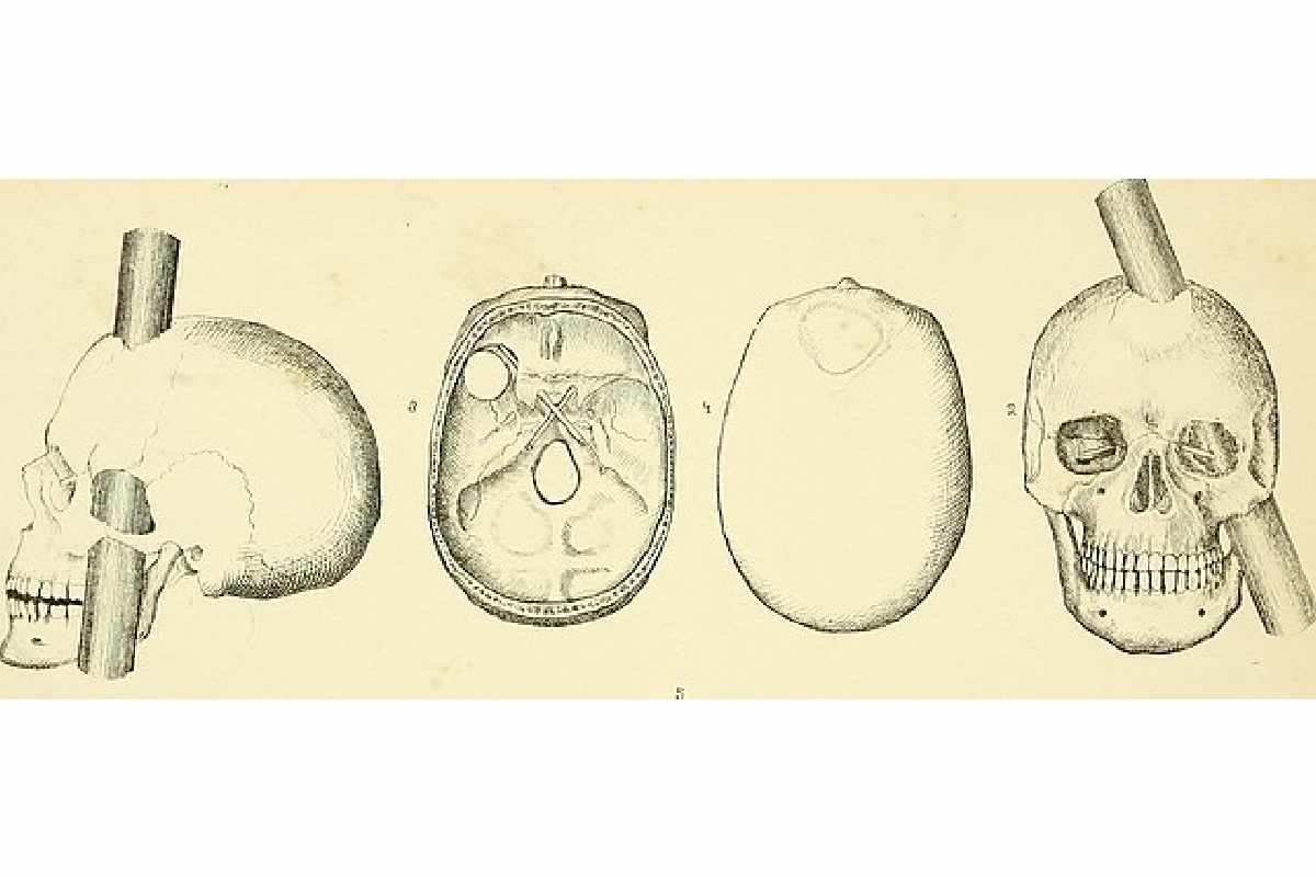 Cranio di Phineas Gage perforato nei disegni